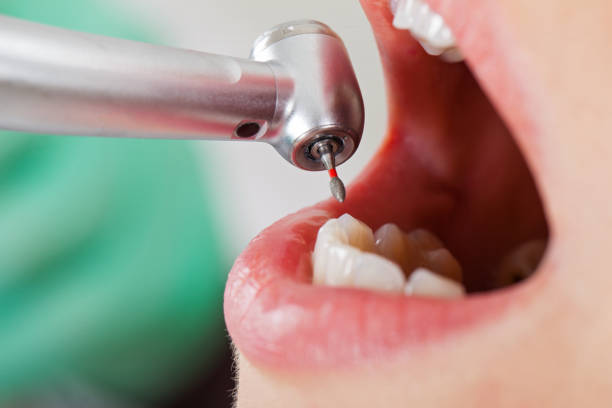 Best Emergency Treatment for Dental Infections or Abscesses in Statesville, NC